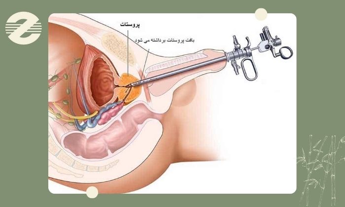 روند نمونه برداری از پروستات روند نمونه برداری از پروستات