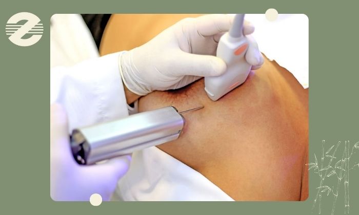 انواع بیوپسی سینه انواع بیوپسی سینه