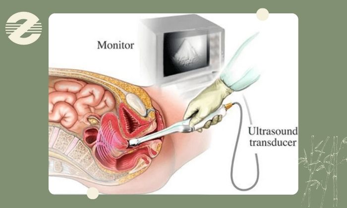 مراحل انجام هیسترو سونوگرافی