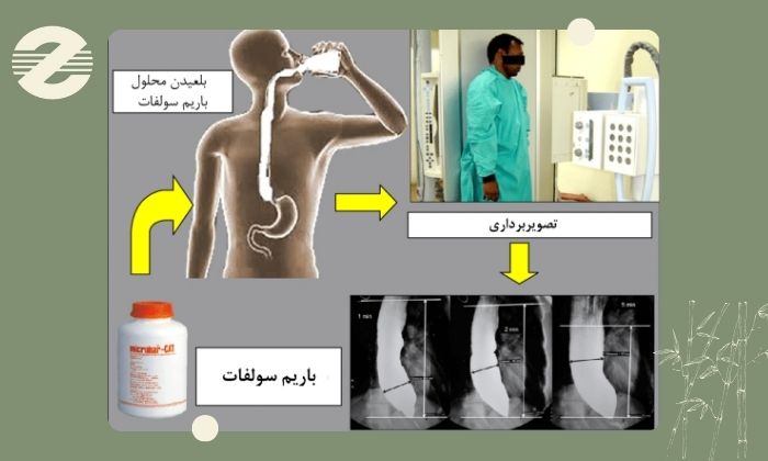 روند تصویربرداری مری و معده با ماده حاجب