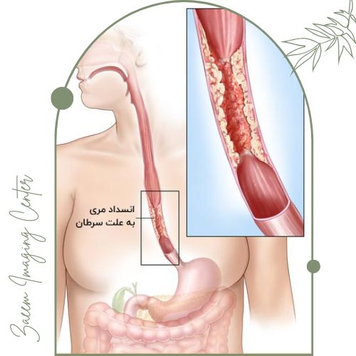 تفسیر نتایج عکس رنگی معده و مری