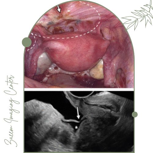 سونوگرافی اندومتریوز سونوگرافی اندومتریوز