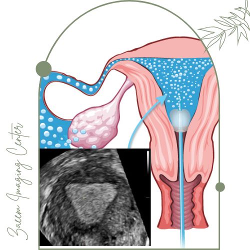 هیستروسونوگرافی هیستروسونوگرافی