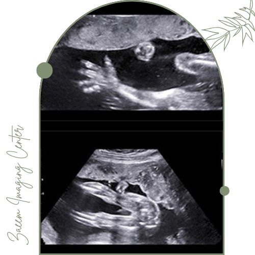 سونوگرافی آنومالی جنین سونوگرافی آنومالی جنین