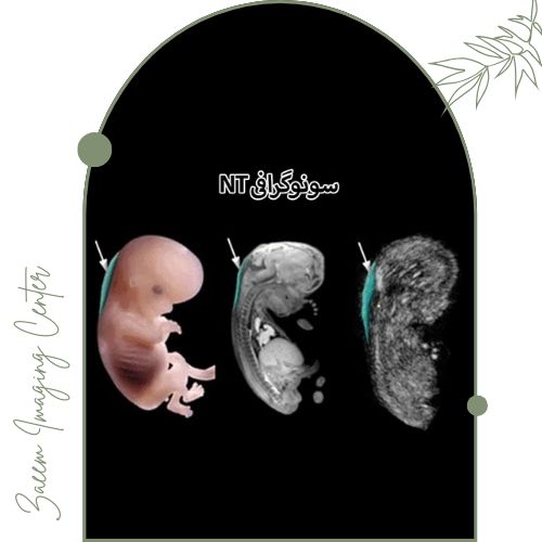 سونوگرافی NT سونوگرافی NT