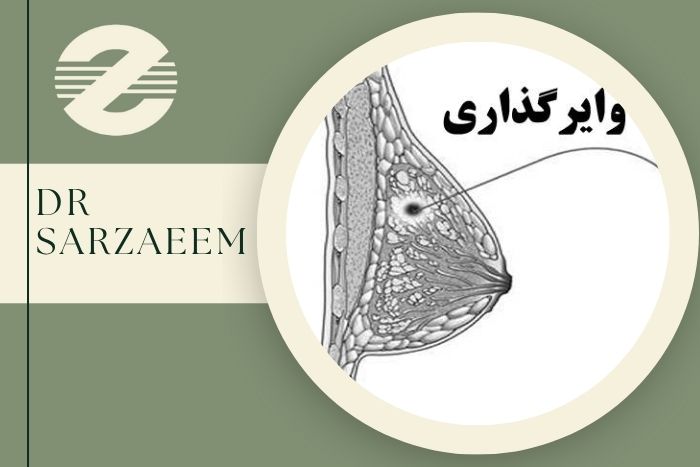 وایر گذاری پستان چگونه انجام می شود و بهترین مرکز انجام آن در کرج