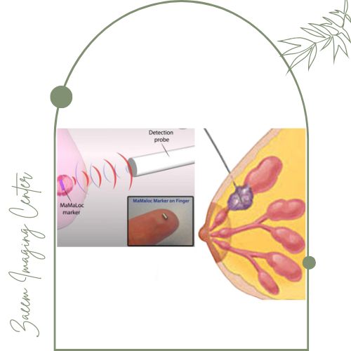 وایر گذاری پستان چیست؟