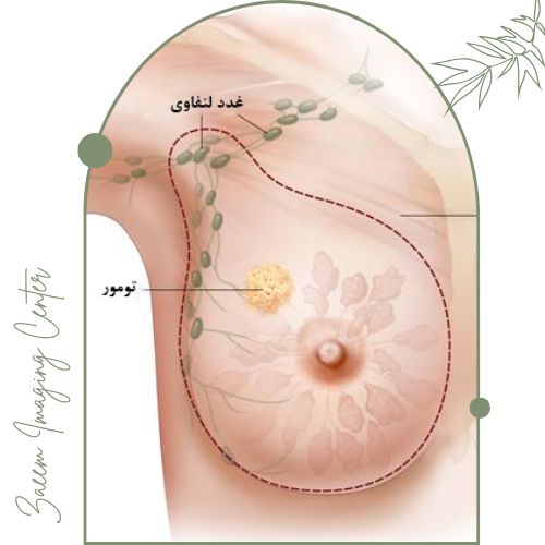 چرا وایرگذاری سینه اهمیت دارد؟