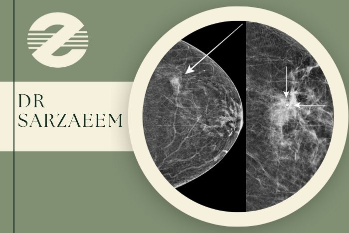 مارکر گذاری پستان چگونه انجام می شود و بهترین مرکز انجام آن در کرج