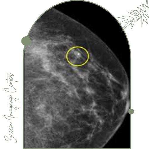 مارکرگذاری پستان چیست؟