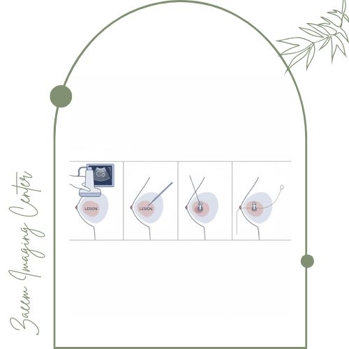 فرایند انجام علامت‌گذاری پستان