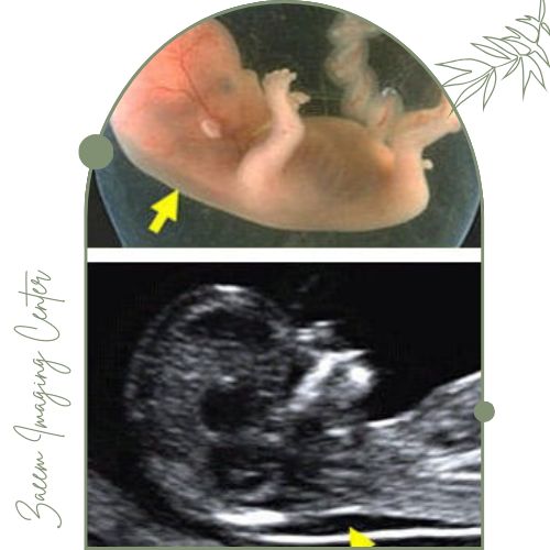 سونوگرافی NT چیست؟ سونوگرافی NT چیست؟