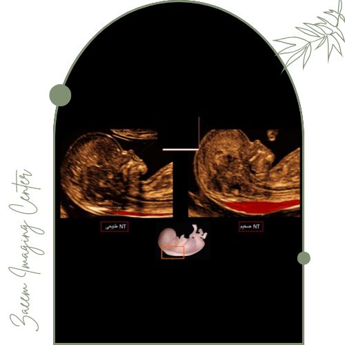 نتیجه و تفسیر غربالگری NT نتیجه و تفسیر غربالگری NT