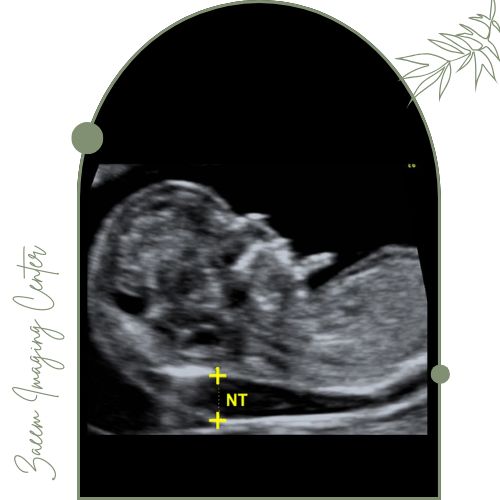 تفاوت سونوگرافی NT با سایر سونوگرافیها تفاوت سونوگرافی NT با سایر سونوگرافیها