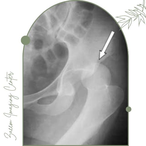 اهمیت سونوگرافی مفصل ران نوزاد اهمیت سونوگرافی مفصل ران نوزاد