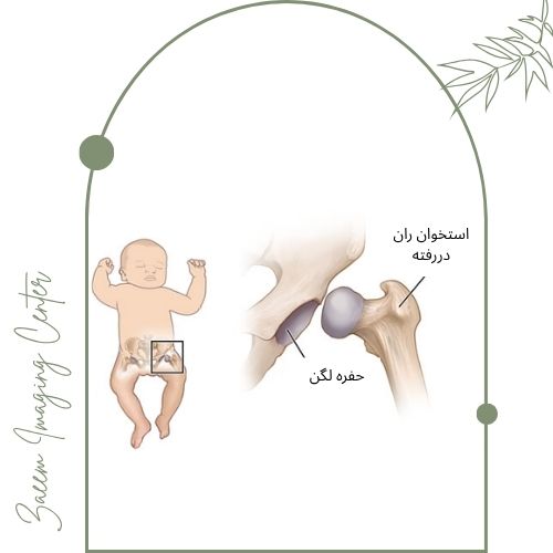 تفسیر نتایج سونوگرافی هیپ تفسیر نتایج سونوگرافی هیپ