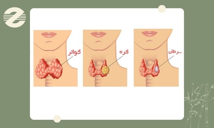 کاربرد سونوگرافی غده تیروئید در تشخیص بیماریها کاربرد سونوگرافی غده تیروئید در تشخیص بیماریها