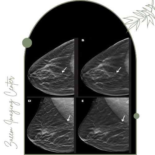 تفسیر نتایج ماموگرام تفسیر نتایج ماموگرام