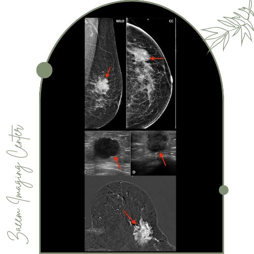 ماموگرافی یا سونوگرافی پستان ماموگرافی یا سونوگرافی پستان