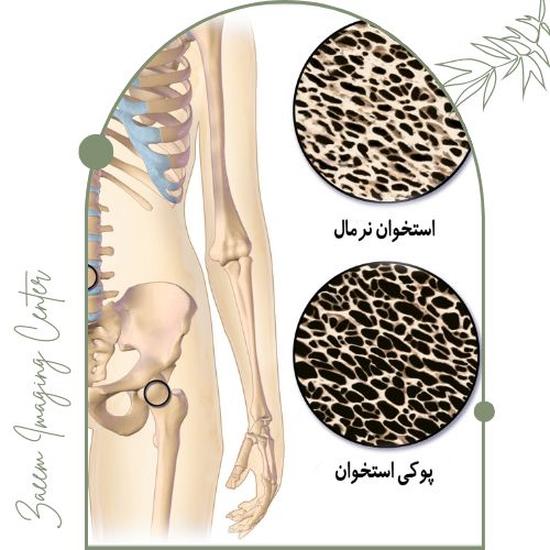 نتایج سنجش استخوانها با دستگاه DXA نتایج سنجش استخوانها با دستگاه DXA