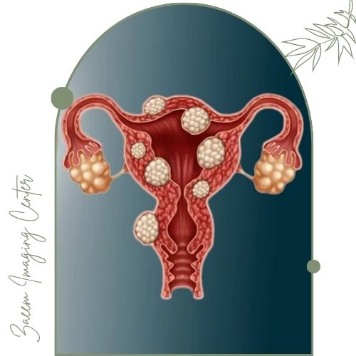 اندومتریوز چیست؟ اندومتریوز چیست؟