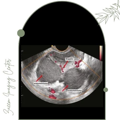 نقش سونوگرافی در تشخیص اندومتریوز نقش سونوگرافی در تشخیص اندومتریوز