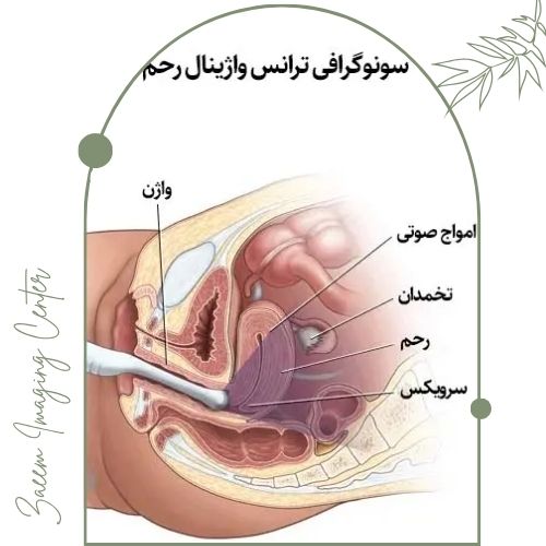 فرایند بررسی اندومتریوز با سونوگرافی فرایند بررسی اندومتریوز با سونوگرافی