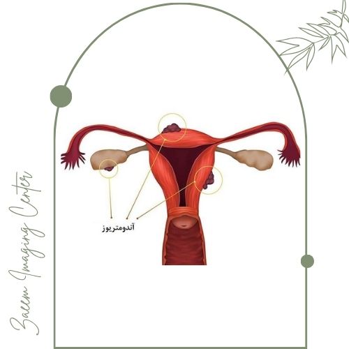 محدودیتهای اندومتریوز با سونوگرافی محدودیتهای اندومتریوز با سونوگرافی