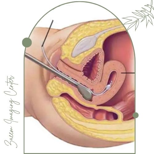 تفاوت هیستروسونوگرافی با سونو واژینال