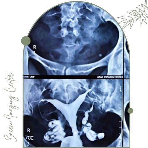 عوارض احتمالی پس از انجام HSG