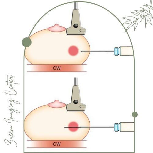 روند انجام نمونه برداری از سینه روند انجام نمونه برداری از سینه