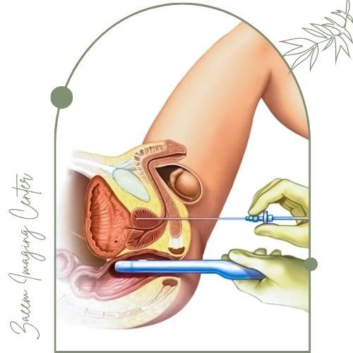 روشهای نمونهبرداری پروستات روشهای نمونهبرداری پروستات