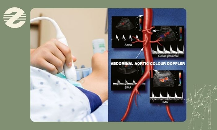 مراقبت‌های بعد از سونوگرافی داپلر از عروق