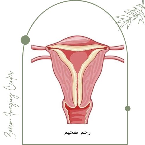 ارتباط ضخیم شدن اندومتر با سرطان رحم