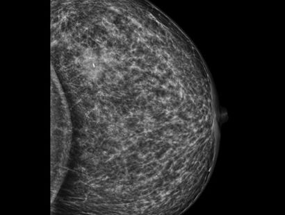 مارکرگذاری تحت گاید سونوگرافی