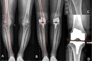رادیوگرافی الایمنت ویو رادیوگرافی الایمنت ویو