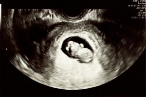 سونوگرافی آنومالی جنین سونوگرافی آنومالی جنین