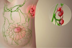 نمونه برداری غدد لنفاوی نمونه برداری غدد لنفاوی