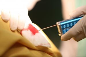 وکیوم بیوپسی سینه وکیوم بیوپسی سینه