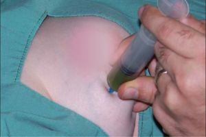 آسپیراسیون کیست پستان آسپیراسیون کیست پستان