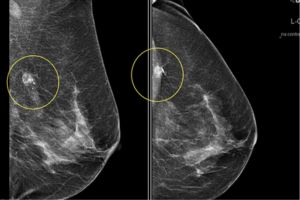 ماموگرافی ماموگرافی