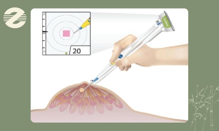 آیا مارکرگذاری پستان درد دارد؟