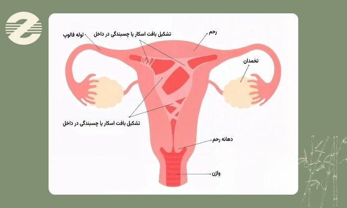 آیا چسبندگی رحم باعث نازایی می‌ شود؟
