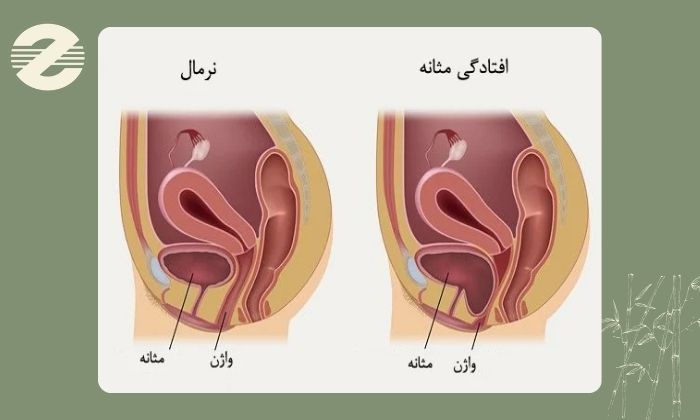 بی اختیاری ادرار با چه بیماری هایی مرتبط است؟