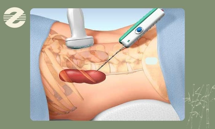 بیوپسی کبد چیست؟