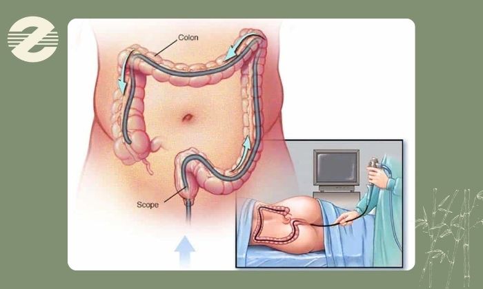تفاوت باریم انما با کولونوسکوپی چیست؟ تفاوت باریم انما با کولونوسکوپی چیست؟