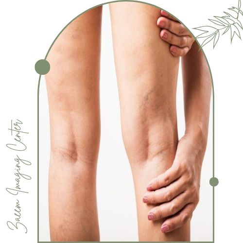 درد واریس پا چه زمانی طبیعی است؟ درد واریس پا چه زمانی طبیعی است؟