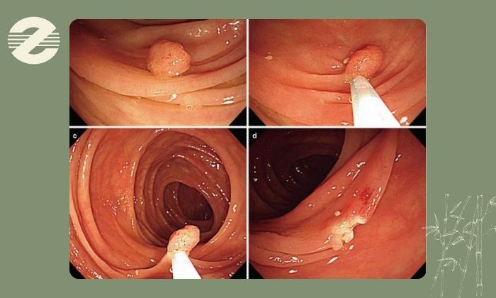 راه های درمان بر اساس شدت علائم