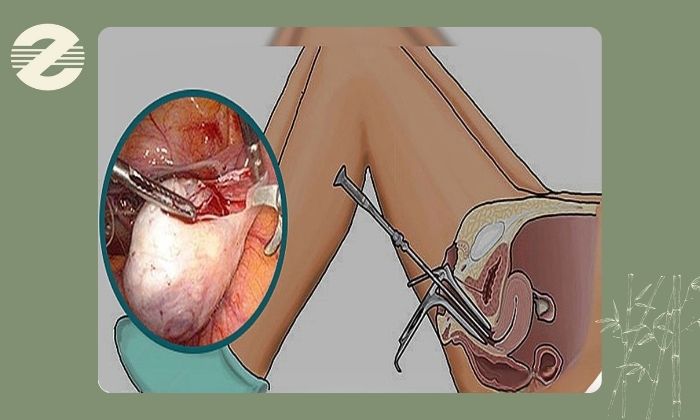درمان چسبندگی ‌های داخل ‌رحمی