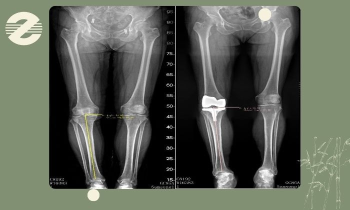 رادیوگرافی الایمنت ویو چیست؟